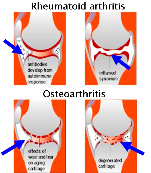 Osteoarthritis vs Rheumatoid Arthritis